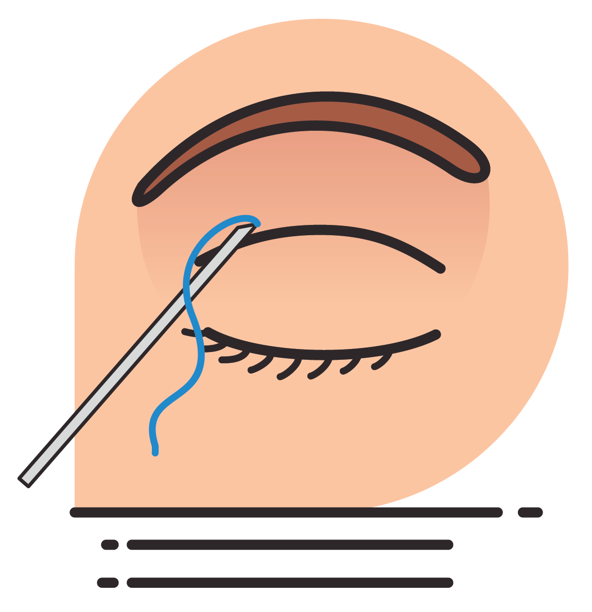 Double Eyelid Surgery (non-incisional)