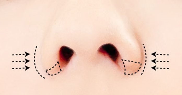 Alar (nose wing) Reduction