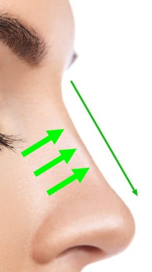 Nose Bridge Heightening