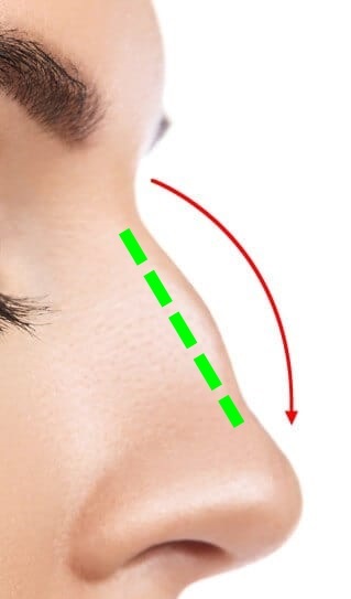 Nose Hump Removal
