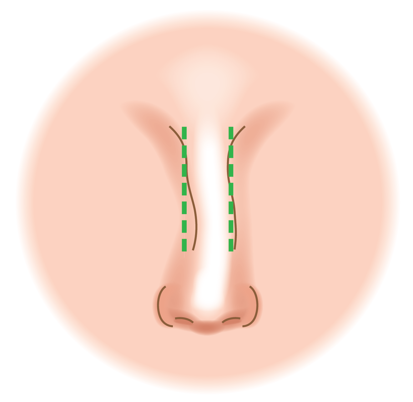 Re-alignment of Crooked Nose Bridge