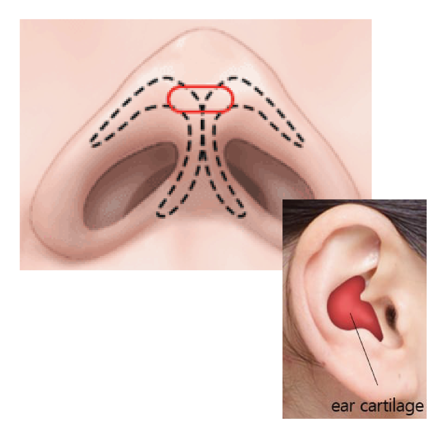 Nose Tip Enhancement