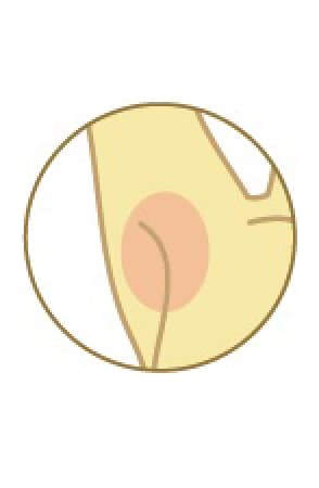 Underarm Laser Hair Removal
