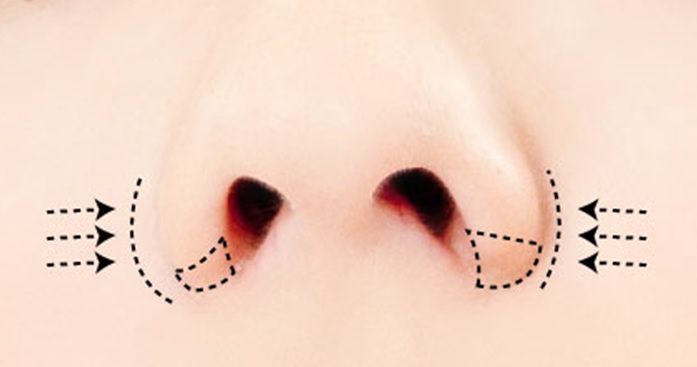 鼻翼の縮小